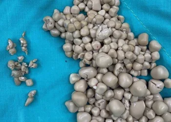 Böbreklerinden 300 taş çıkarıldı