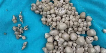 Böbreklerinden 300 taş çıkarıldı