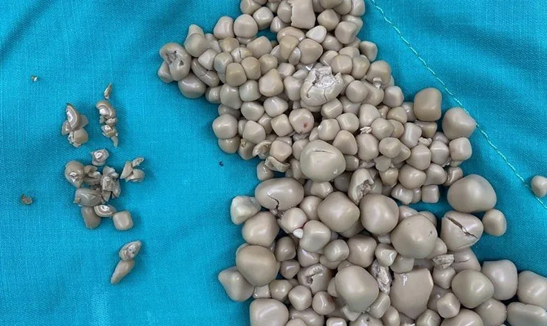 Böbreklerinden 300 taş çıkarıldı