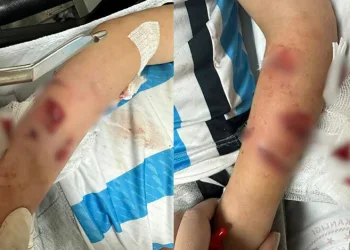 Sevdiği köpeğin saldırısına uğradı