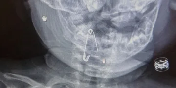 Bebeğin boğazına çengelli iğne kaçtı