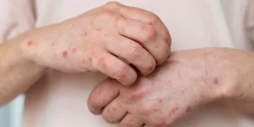 Soğuklarda cilt kaşıntılarının sebebine dikkat