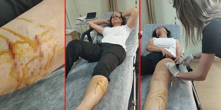 Spor yaparken köpekler saldırdı