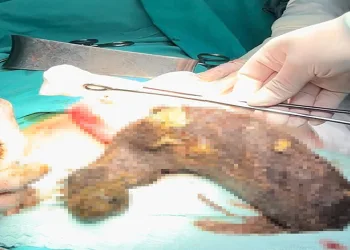 Genç kızın karnından 2 kilogram kıl yumağı çıktı