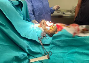 Kayseri’de 14 yaşındaki kızın midesinden 3.5 kilo saç kılı çıktı