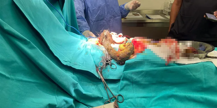 Kayseri’de 14 yaşındaki kızın midesinden 3.5 kilo saç kılı çıktı