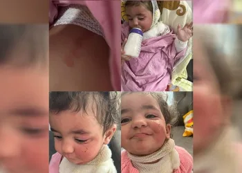 Kreşte çocuğun üzerine kahve döküldü