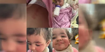 Kreşte çocuğun üzerine kahve döküldü