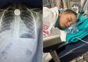 Metal para yutan çocuk ölümden döndü