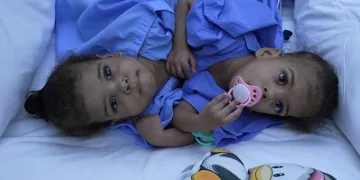 Yapışık ikizler Türkiye’de hayata tutundu