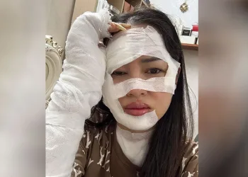 Elinde patlayan balon yüzünü yaktı