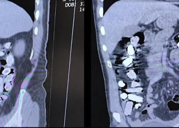 Mide ve bağırsaklarından 1 kilo 340 gram uyuşturucu çıktı