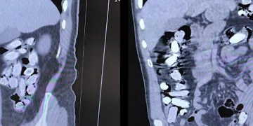 Mide ve bağırsaklarından 1 kilo 340 gram uyuşturucu çıktı