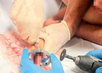Bursa’da çocuğun parmağı çeşme aynasına sıkıştı