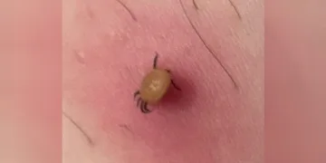 “Kene ısırığı belirtisiz başlar”