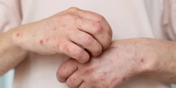 Mantar enfeksiyonları hayat kalitenizi düşürmesin