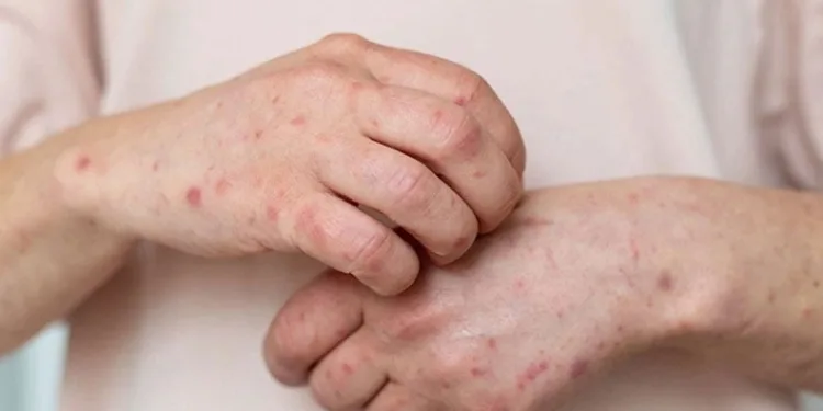 Mantar enfeksiyonları hayat kalitenizi düşürmesin