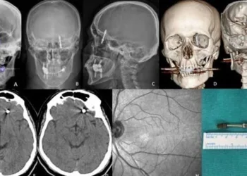 Beynine saplanan implant hayatını kararttı