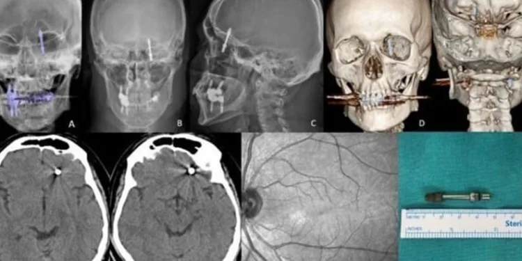 Beynine saplanan implant hayatını kararttı