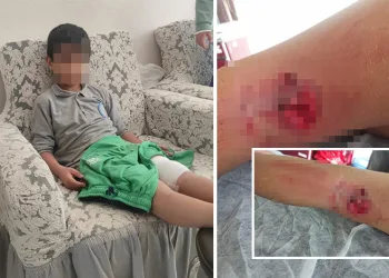 Okula giderken sokak köpeğinin saldırısına uğradı