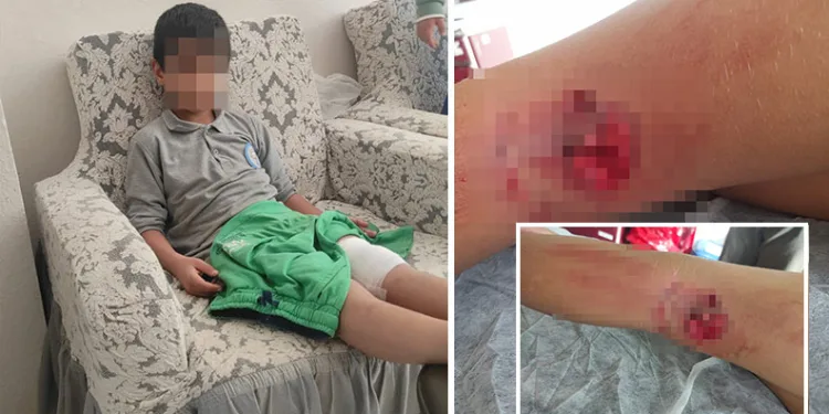 Okula giderken sokak köpeğinin saldırısına uğradı