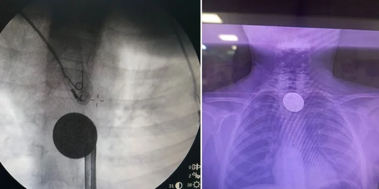 Siirt’te boğazına madeni para kaçan çocuk, doktorların müdahalesi ile kurtarıldı