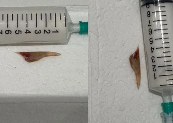 Boğazına saplanan 5 santimlik kemik öldürüyordu