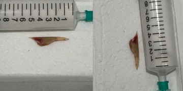 Boğazına saplanan 5 santimlik kemik öldürüyordu